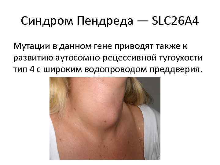 Синдром Пендреда — SLC 26 A 4 Мутации в данном гене приводят также к
