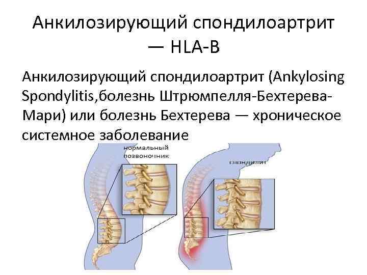 Анкилозирующий спондилоартрит презентация