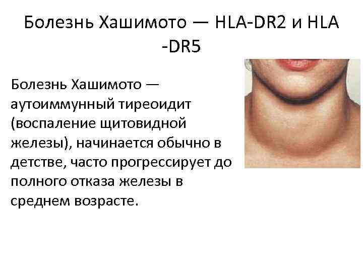 Щитовидная железа симптомы у мужчин внешние признаки