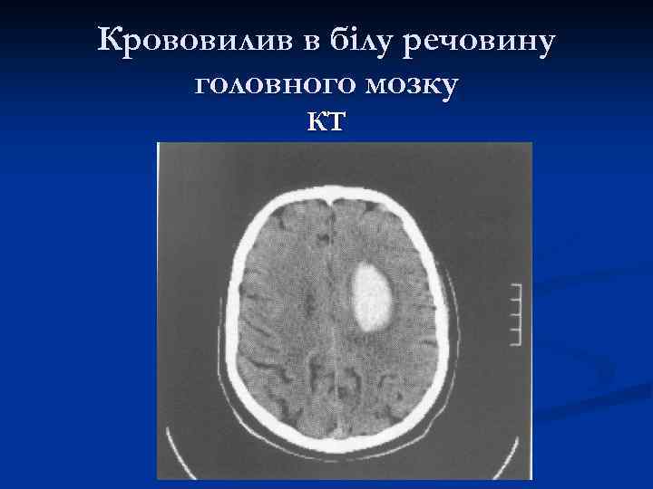 Крововилив в білу речовину головного мозку КТ 