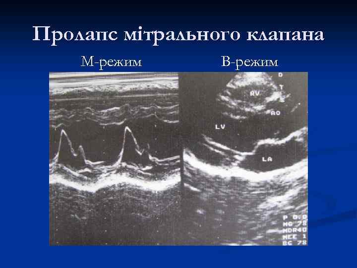 Пролапс мітрального клапана М-режим В-режим 