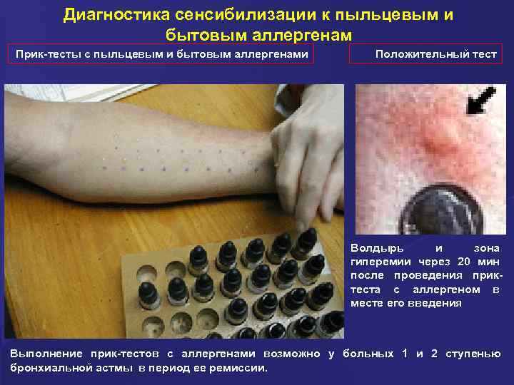Диагностика сенсибилизации к пыльцевым и бытовым аллергенам Прик-тесты с пыльцевым и бытовым аллергенами Положительный