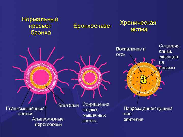 Нормальный просвет бронха Бронхоспазм Хроническая астма Воспаление и отек Эпителий Сокращение Гладкомышечные гладкоклетки мышечных