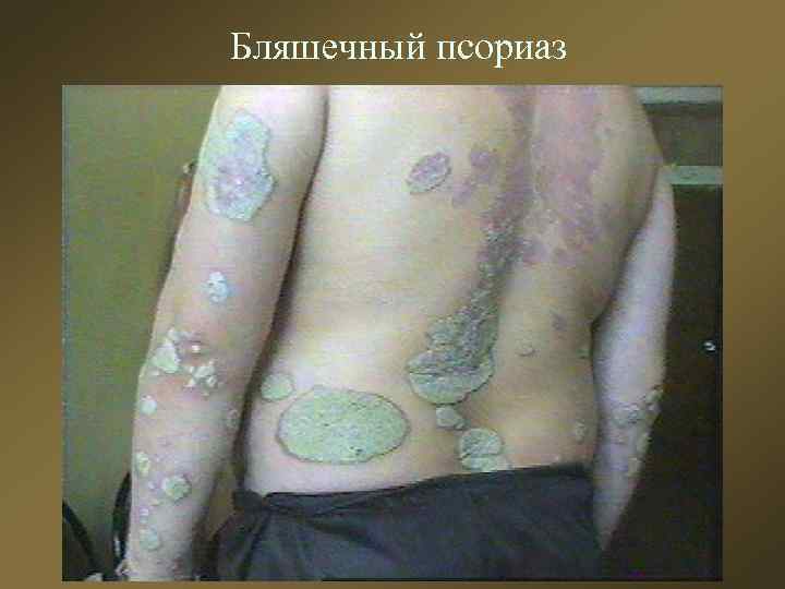 Бляшечный псориаз 