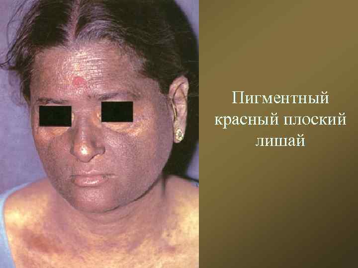 Пигментный красный плоский лишай 