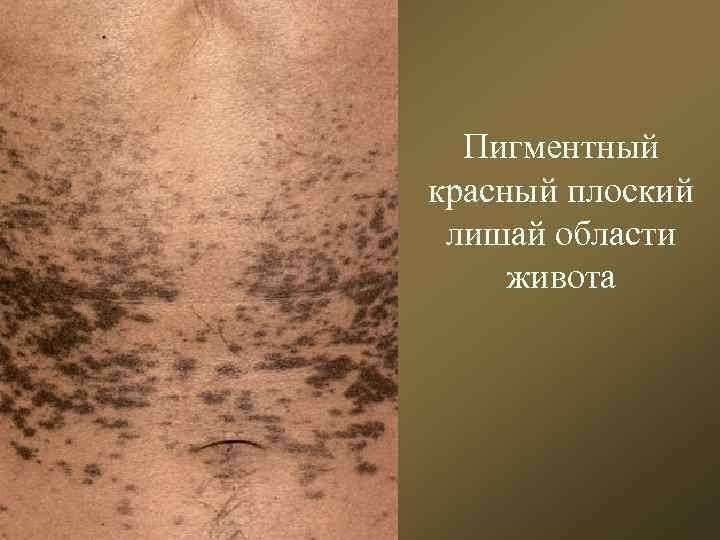 Пигментный красный плоский лишай области живота 
