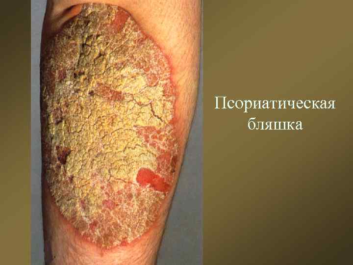 Псориатическая бляшка 
