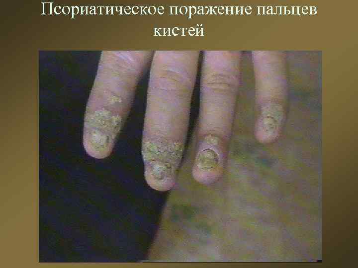 Псориатическое поражение пальцев кистей 