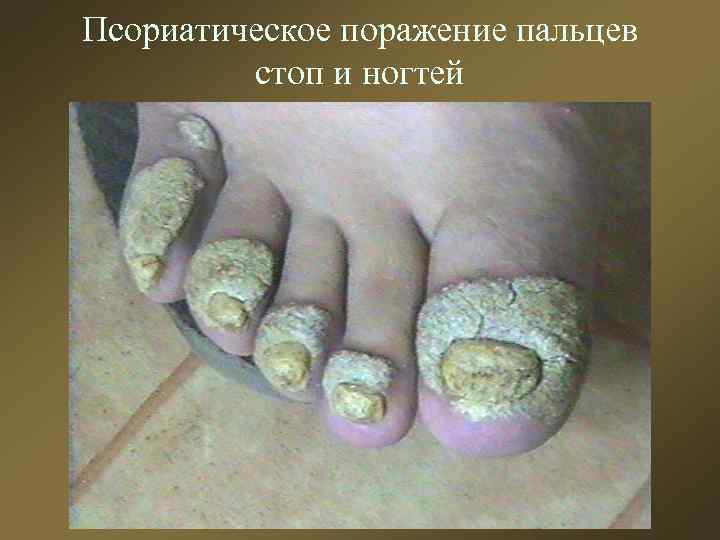 Псориатическое поражение пальцев стоп и ногтей 