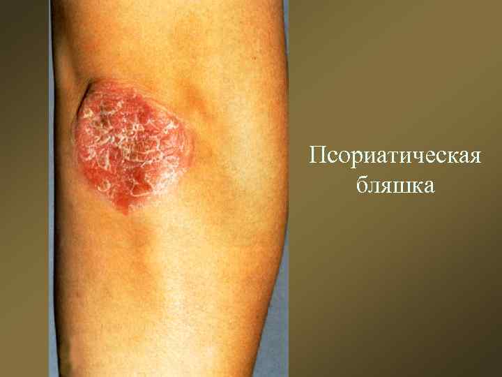 Псориатическая бляшка 