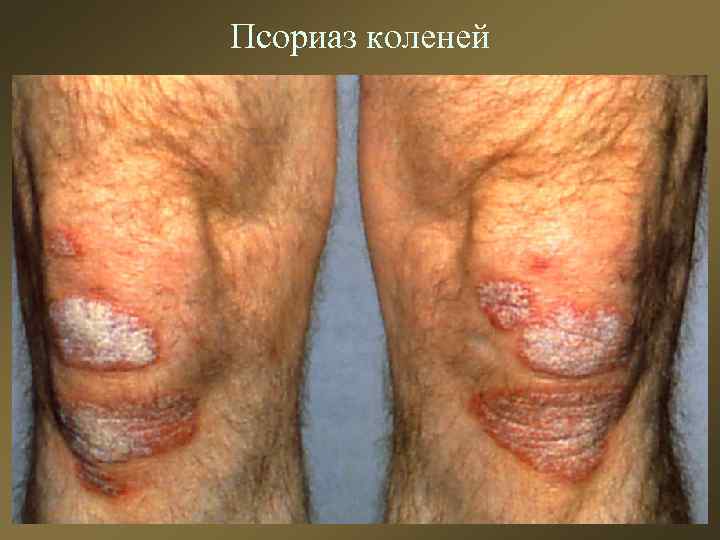 Псориаз коленей 