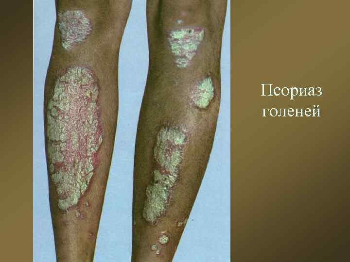Псориаз голеней 