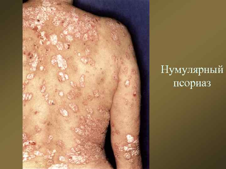 Нумулярный псориаз 