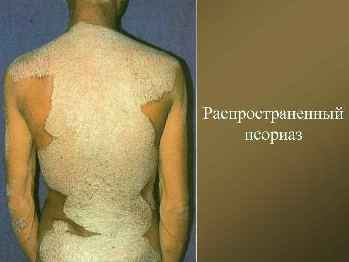 Распространенный псориаз 