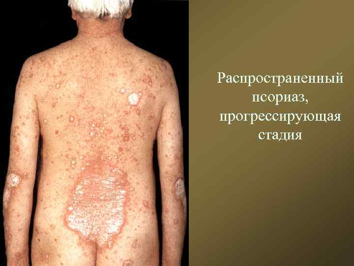 Распространенный псориаз, прогрессирующая стадия 