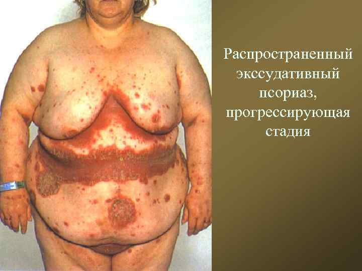 Распространенный экссудативный псориаз, прогрессирующая стадия 