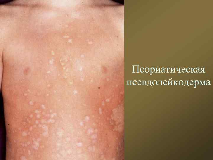 Псориатическая псевдолейкодерма 