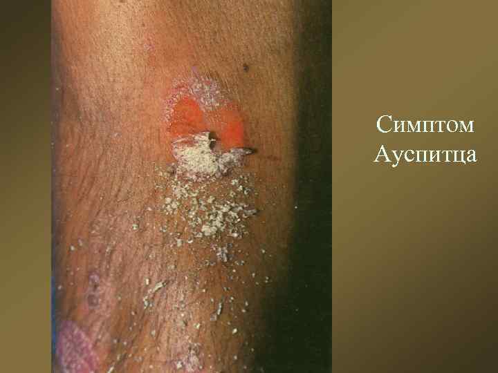 Симптом Ауспитца 