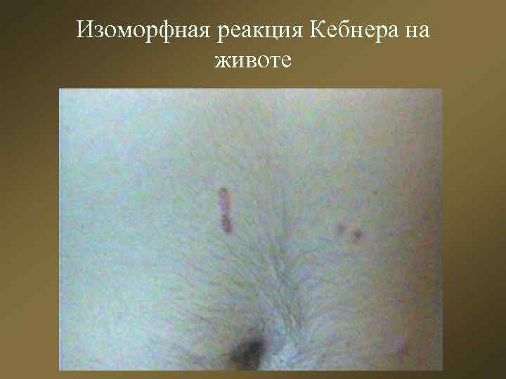 Изоморфная реакция Кебнера на животе 