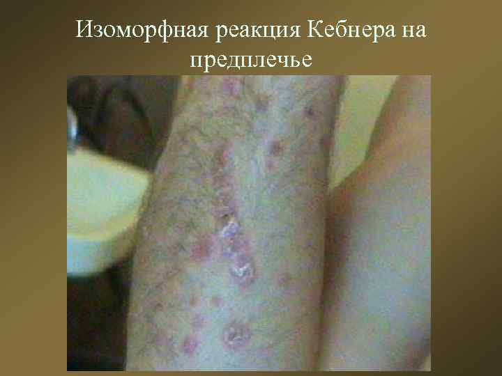 Изоморфная реакция Кебнера на предплечье 