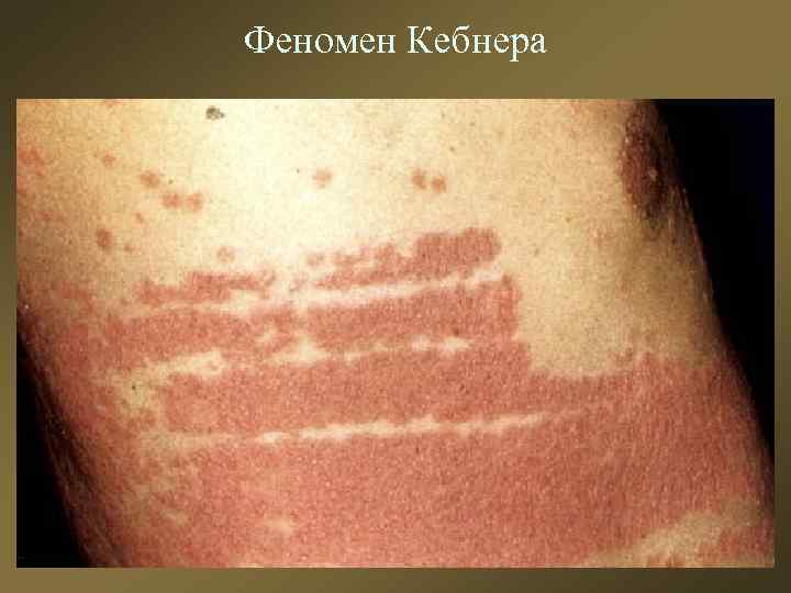 Феномен Кебнера 