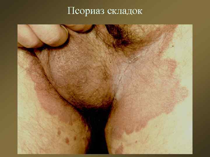 Псориаз складок 