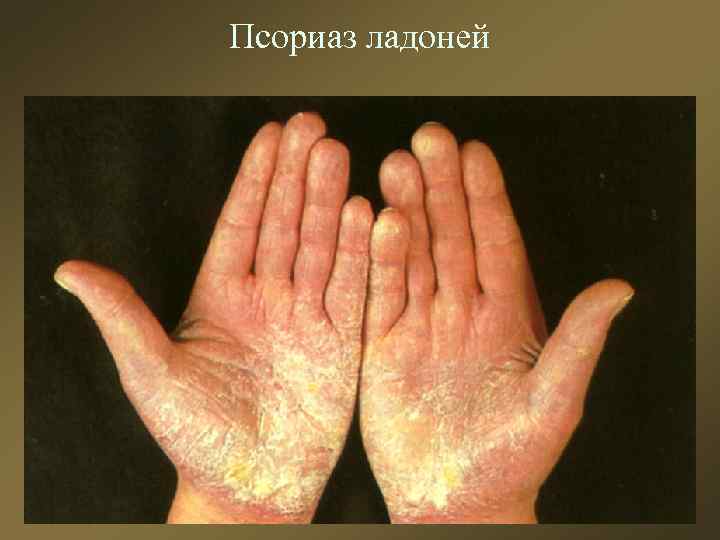 Псориаз ладоней 