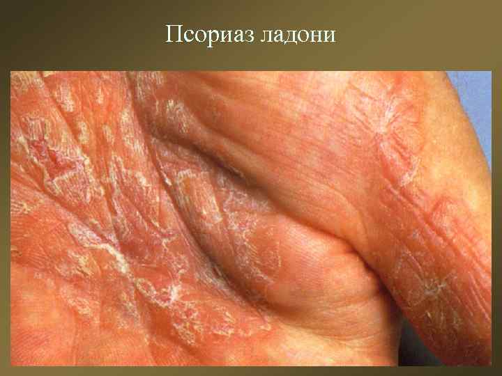 Псориаз ладони 