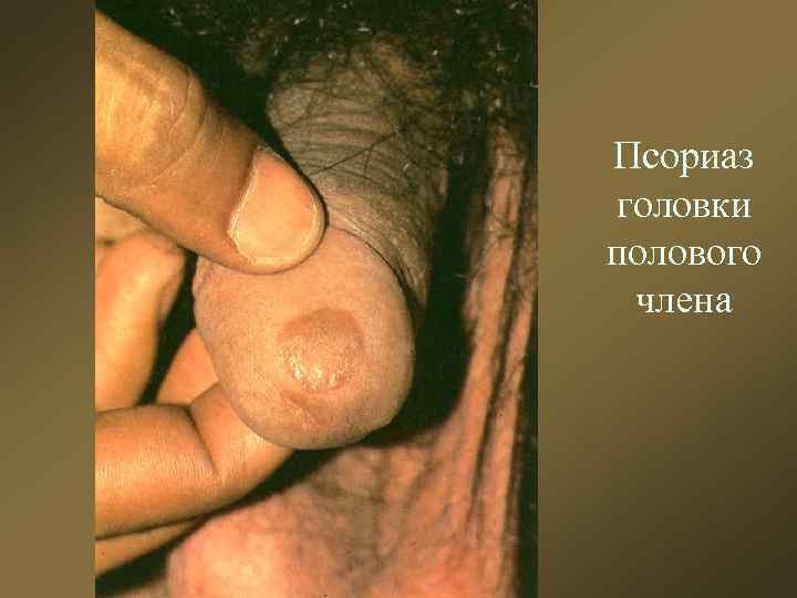 Псориаз головки полового члена 