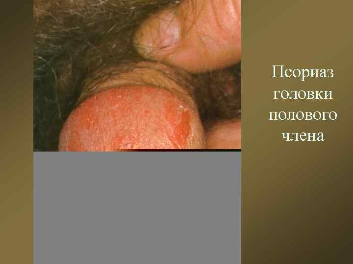 Псориаз головки полового члена 
