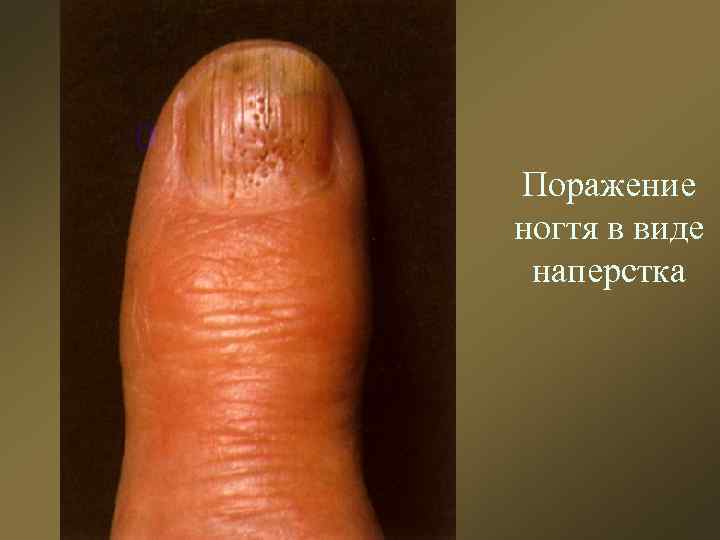 Поражение ногтя в виде наперстка 