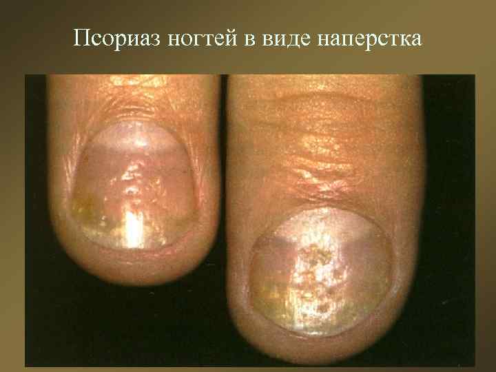 Псориаз ногтей в виде наперстка 