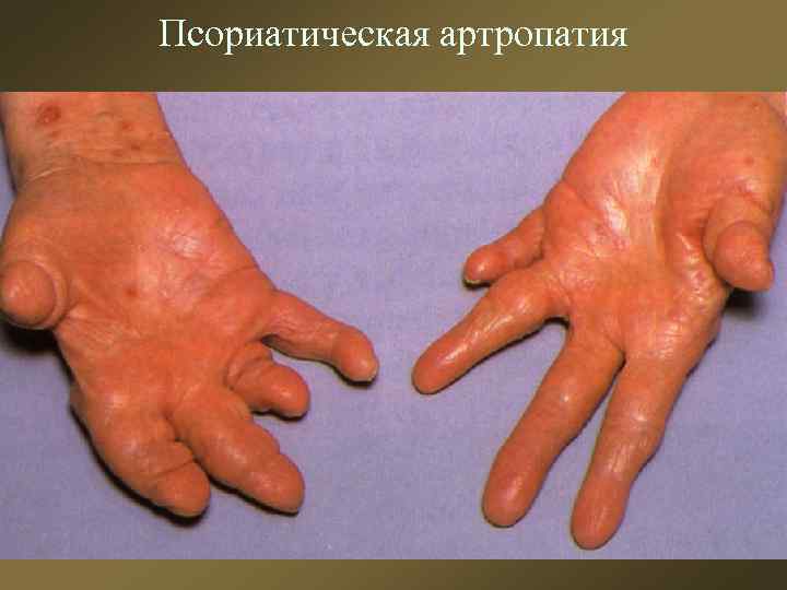 Псориатическая артропатия 