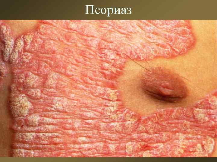 Псориаз 