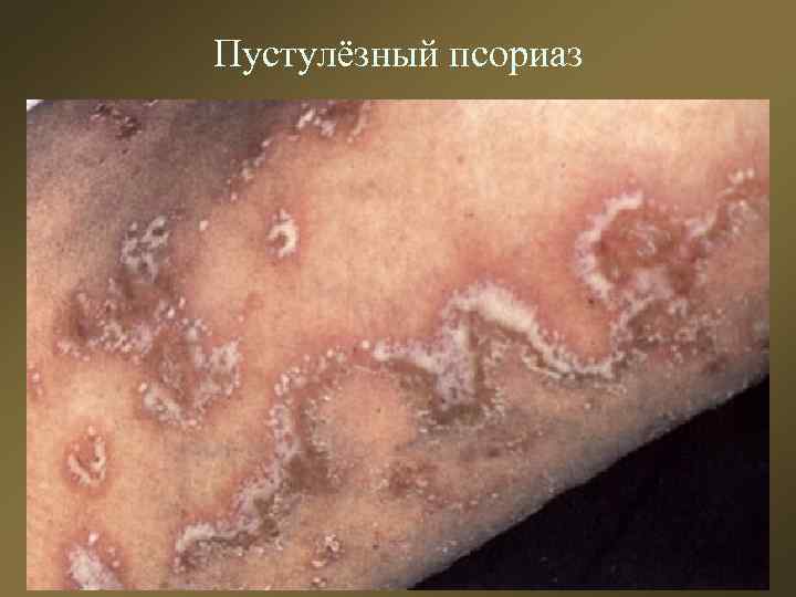 Пустулёзный псориаз 