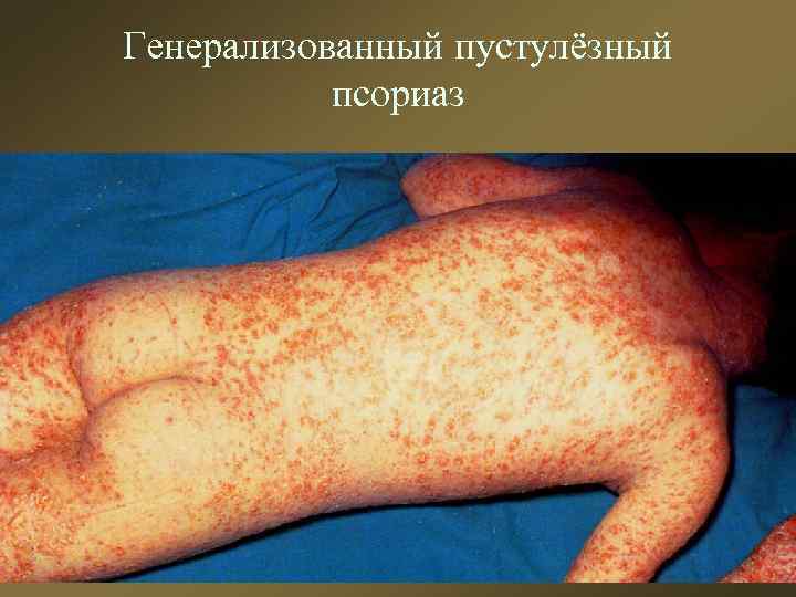 Генерализованный пустулёзный псориаз 