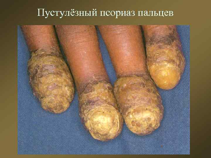 Пустулёзный псориаз пальцев 