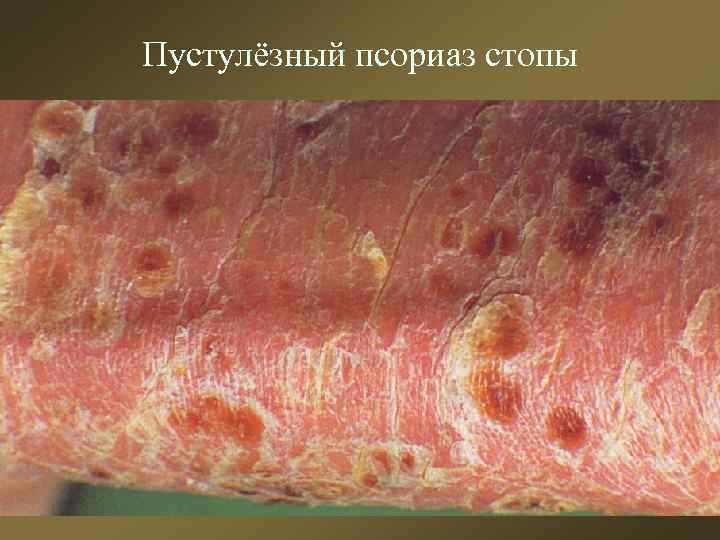Пустулёзный псориаз стопы 