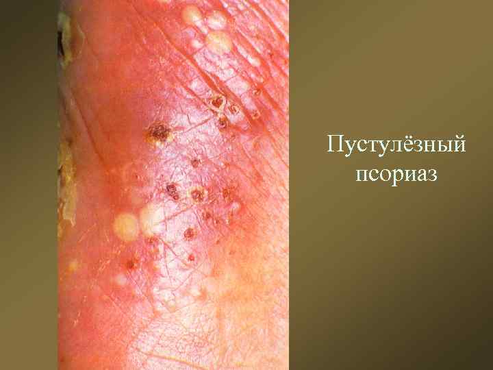 Пустулёзный псориаз 