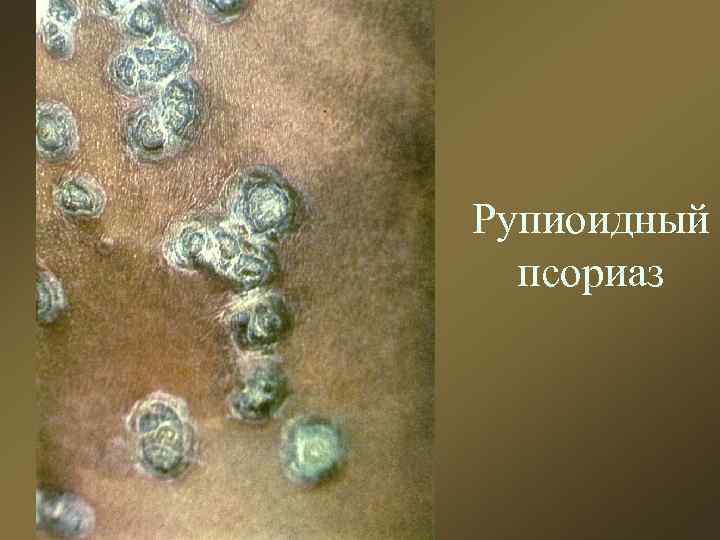 Рупиоидный псориаз 