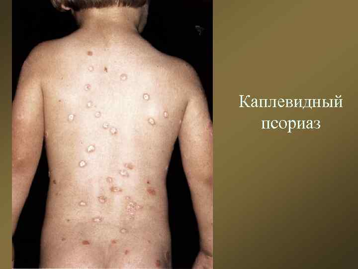 Каплевидный псориаз 