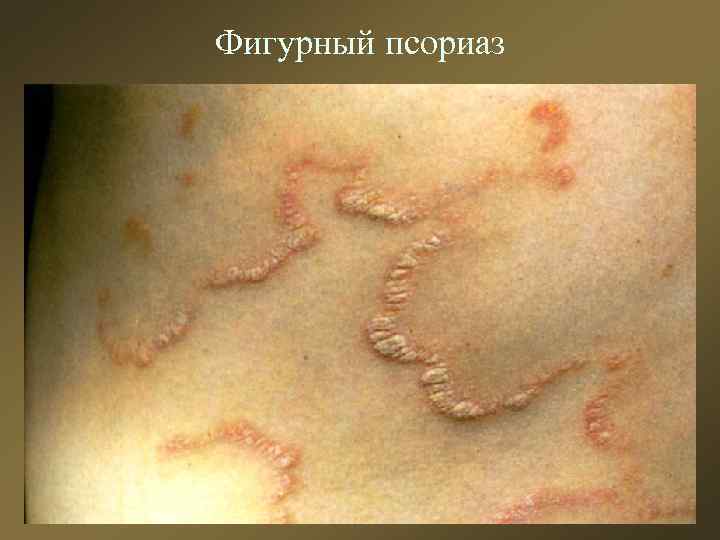 Фигурный псориаз 