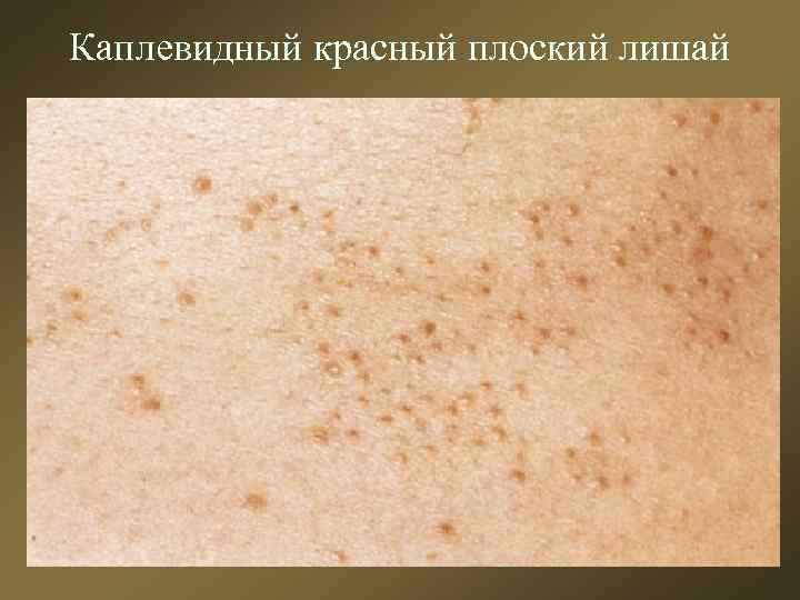 Каплевидный красный плоский лишай 