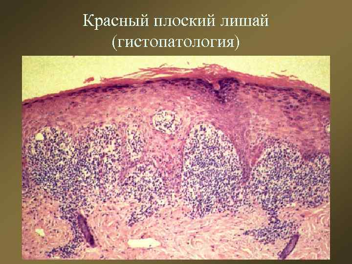 Красный плоский лишай (гистопатология) 
