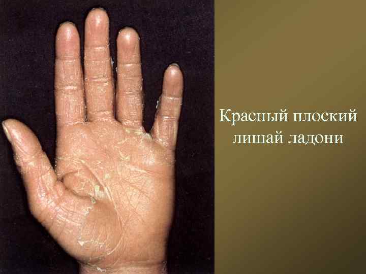 Красный плоский лишай ладони 