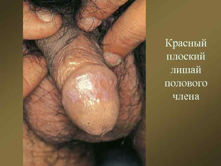 Красный плоский лишай полового члена 