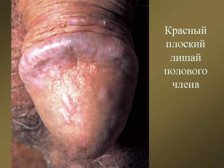 Красный плоский лишай полового члена 