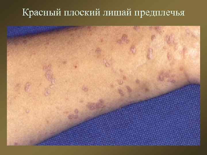 Красный плоский лишай предплечья 