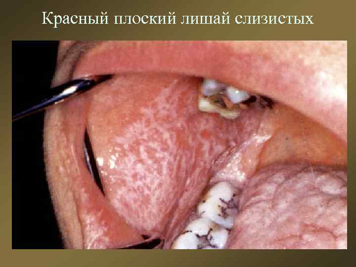 Красный плоский лишай слизистых 