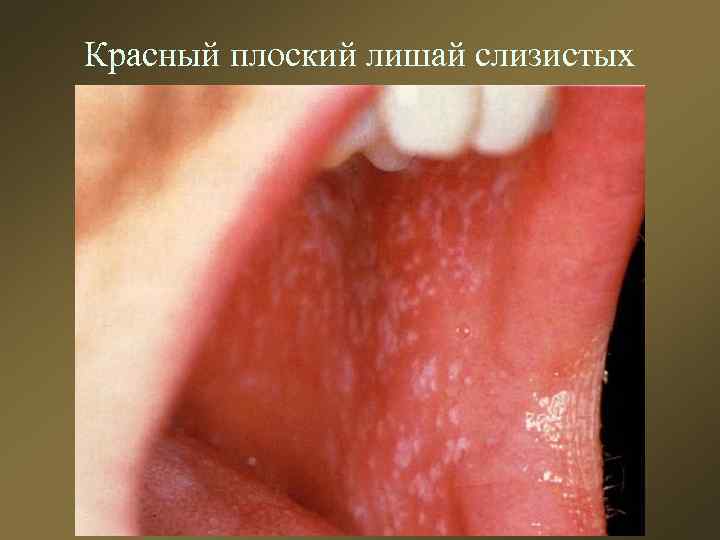 Красный плоский лишай слизистых 